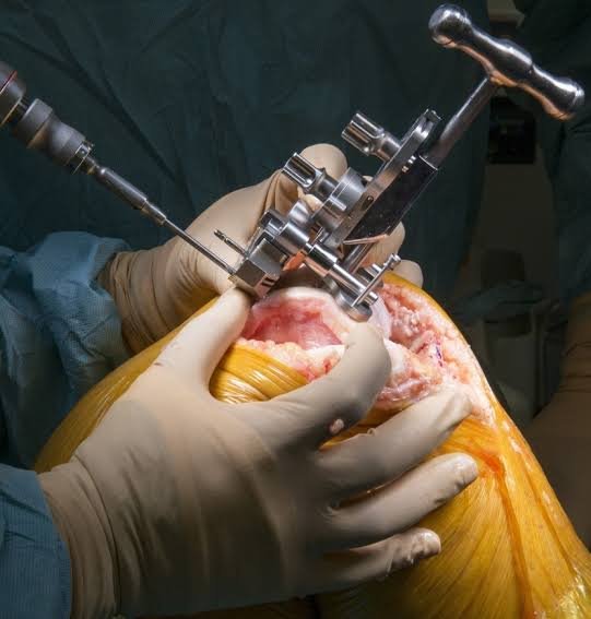 Total Knee Replacement Surgery