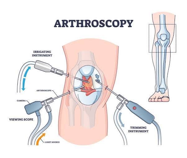 Arthroscopic Surgery