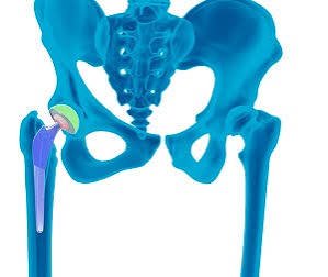 Robotic Total Hip Replacement (THR)