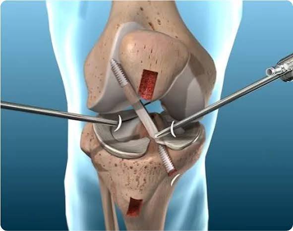 Revision Joint Replacement Surgery