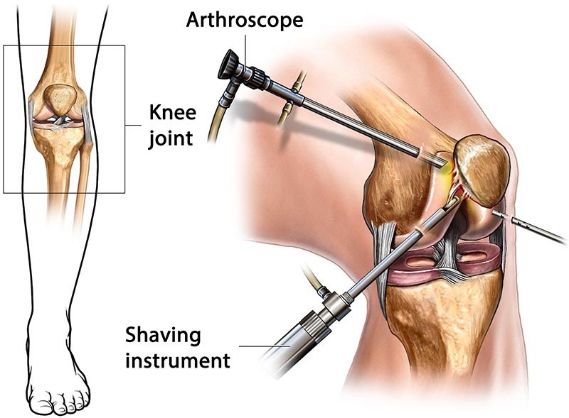 Arthroscopy Knee